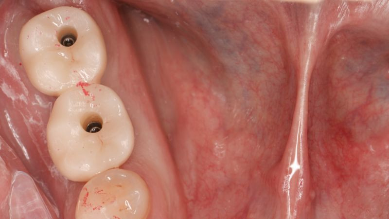 Имплантация зубов ПОСЛЕ